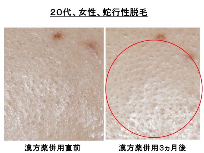 円形脱毛症　病院